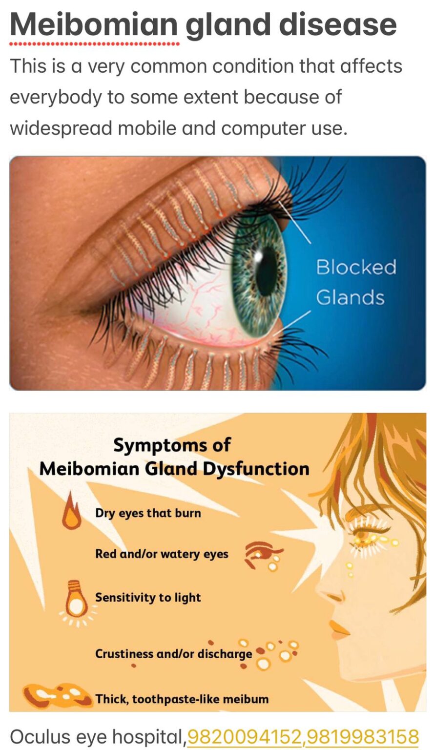 Meibomian Gland Dysfunction And Treatment Welcome To Oculus Eye Hospital Mumbai 